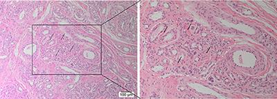 Stemness-Associated Markers Are Expressed in Extracranial Arteriovenous Malformation